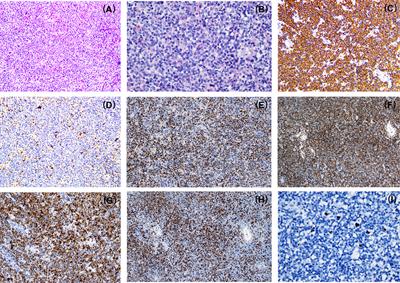 Case report: Identification of atypical mantle cell lymphoma with CCND3 rearrangement by next-generation sequencing